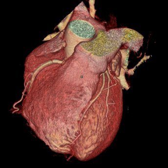 Cardiac CT pearls | State-of-the-art advances | Improving awareness & ameliorating misconceptions of Cardiac CT | Tweets=own
#yesCCT