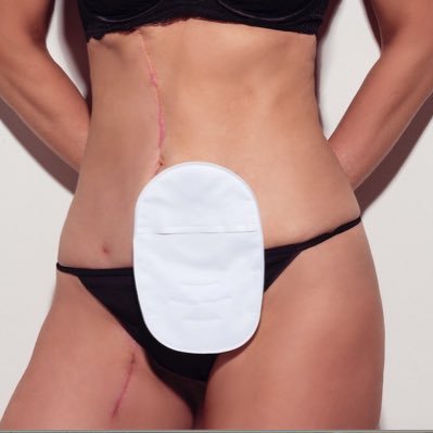 thinkcanceruk's profile picture. I DIDN'T THINK BOWEL CANCER. BUT IT WAS. Stage 3 bowel cancer survivor raising awareness of symptoms and getting people to get their ass to the doctor ASAP!