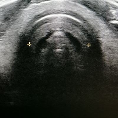 @trache_phd