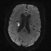 Leading a global project to identify MRI-confirmed lacunar stroke patients for genetic analysis at @Cambridge_Uni