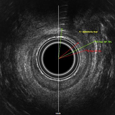 Pelvic Floor/ Transrectal Ultrasound