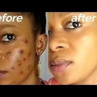 Dark spots on the face are a common problem. They can be caused by various factors such as acne, sun damage, aging and other factors. To remove them,you need it