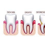 Pagina estudiantil con información sobre la gingivitis en Jalisco