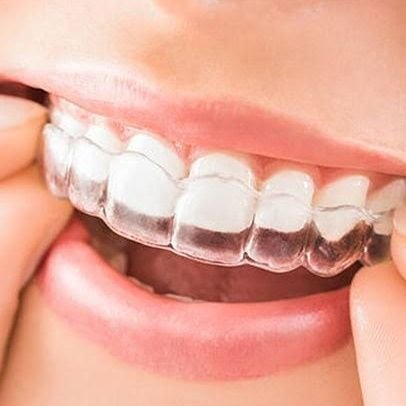 Will share data on Clear Aligners- Information, Science, Research, Results. Only Authenticated Facts