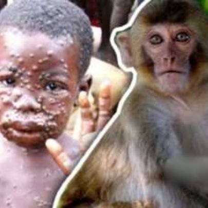 statistics of monkeypox in all over the world.