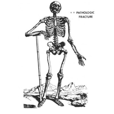 Math, bones, and a general dearth of medical advice 🦴🔨