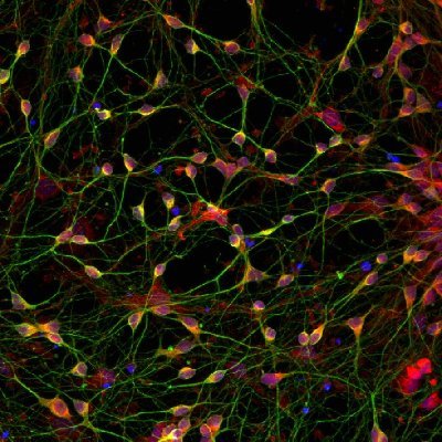 Lab of Prof. Lena Burbulla | Studying dopaminergic neuron vulnerability in PD & NBIA using stem cell models | @DZNE_de @SyNergy_Cluster @LMU_Muenchen