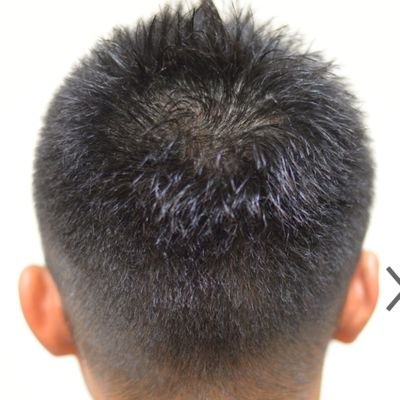 40歳👨会社員。以下、発毛までの奮闘記。
◼️ハゲ歴25年(中1から)
◼️つむじが特に薄く、柔らかい髪質が更に災い😢
◼️アデランスは高過ぎて断念
◼️市販の育毛剤ほぼ全て試したが効果❎
◼️海外から個人輸入した◯◯ペシアも効果❎
◼️半年前、⏬のオンライン処方を知る😊
◼️ついに奇跡の発毛を果たす💮