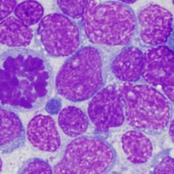 Heme_Team's profile picture. Diverse team researching the role of splicing factor gene mutations in🩸#MDS and heme malignancies @CU_Pathology⛰️. Support: @NIH_NHLBI, @EdwardPEvansFdn