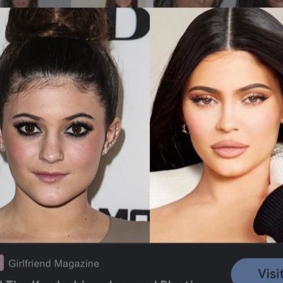 Kim’s lip filler Profile