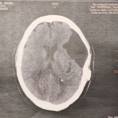 This is my Brain 🧠 scan after surgery