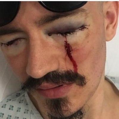 AVRuinedMyEyes's profile picture. I was illegally operated on by optometrist Johann Panthakey @ AccuVision on 28 December 2016. My records were signed by Dr Prashant Jindal, who I never met.