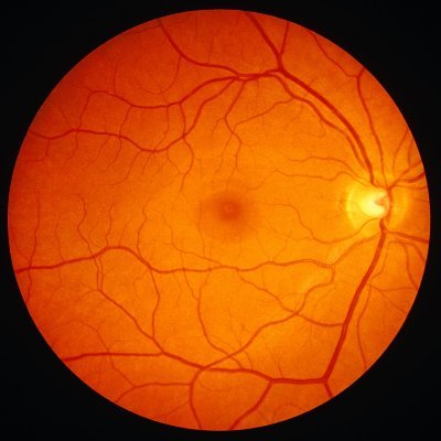 A low-cost open Ophthalmoscope to capture fundus images equipped with open software for diagnosing eye diseases such as diabetic retinopathy