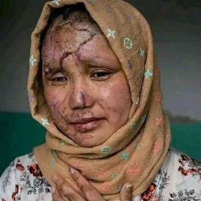 نسل کشی هزاره هارو متوقف کنید...انسانم ارزو هست🇦🇫❤😢
نسل کشی هزارها رو متوقف کنید...😭
#StopHazaraGenocide