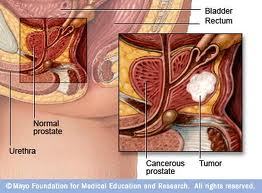 Get Prostate Cancer article here