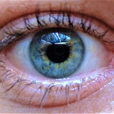 Diagnosed with Ocular Melanoma in the Choroidal layer of my right eye.
Researching what I can about this rare & aggressive cancer.