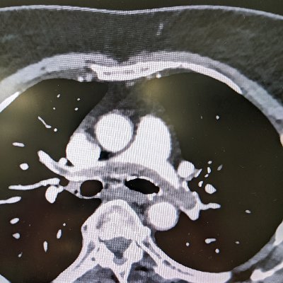 EM/(T)EMS docta in Philadelphia.
Air goes in and out, blood goes round and round. 
Tweets≠medical advice.Views are my own & do not represent employer#medtwitter