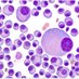 Myeloma-facts (@myelomaquiz) Twitter profile photo Myeloma-facts (@myelomaquiz) Twitter profile photo