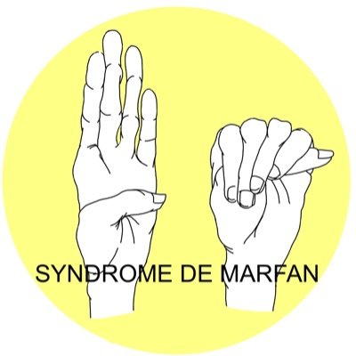 Holà, somos 5 estudiantes en fisioterapia tratando del síndrome de Marfan y buscando sus causas y tratamientos. 
#SíndromedeMarfan #salud #marfansyndrome #med