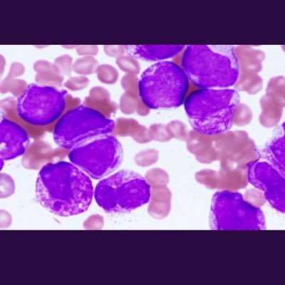 Manzoor99121959's profile picture. Hemato-Oncologist /internist,special interest in BMT /Cart T Cell therapy;immunotherapy /TKI use in LUNG/RCC/Bladder