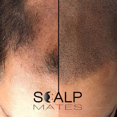 Scalp Micropigmentation (SMP) is a non-invasive cosmetic procedure that involves the application of pigment into the scalp to create the illusion of hair.