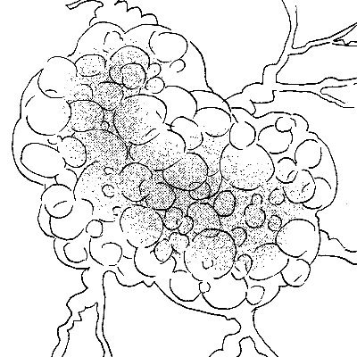 漫画家。 直腸がん、肝臓など転移ありでステージ4(2019年)。抗ガン剤、放射線、手術を経て大体4年が経過。闘病中の日記を漫画にした『断腸亭にちじょう』を連載中。 stageiv colorectalcancer Colon Cancer