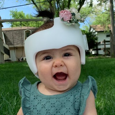 Leading plagiocephaly treatment provider and the only manufacturer of the FDA-cleared DOC Band®. Schedule a free evaluation at the link below!