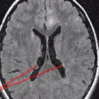 Tuberous Sclerosis Profile