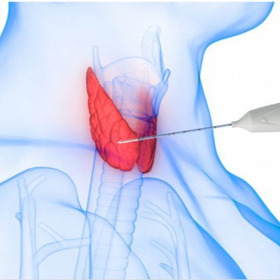 NASIT is a multidisciplinary society dedicated to Interventional Thyroidology