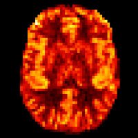 ISMRM Perfusion Study Group (@ismrm_perfusion) 's Twitter Profile