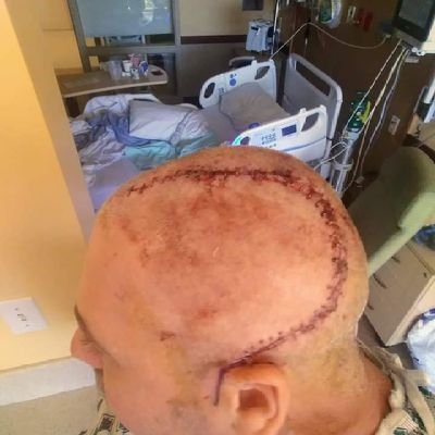 A little over 4 yrs ago I crushed the left side of my skull I was dead for over 4 mins unconscious for 2 months had 5 brain surgeries in 3 months let's go