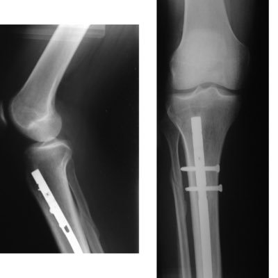 MD @tecdemonterrey, MPH @imperialcollege, Wanna-be Orthopod 🦴