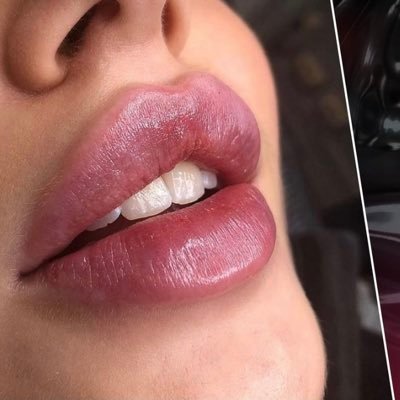 #AUMENTO DE LABIOS CON #ÁCIDO #HIALURÓNICO,#BÓTOX esteticista rusa en #Madrid 26 de junio asta 2 de julio cita previa escríbeme por WhatsApp +34617694132
