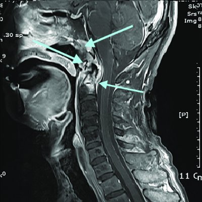 My entire adult life has been a daily struggle with #cervicalspine instabi(ity symptoms, and now totally disabling and untreated #CCI and #MECFS.

Please help!