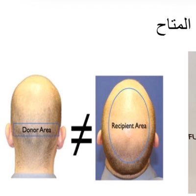 FRCPC, ABD,ABHRSاستشاري مركز أدمه ل #زراعة_الشعر #الرياض جامعة تورونتو والبورد الامريكي ل #زراعة_الشعر واتس 0507773223 https://t.co/SE710Eb4Wf