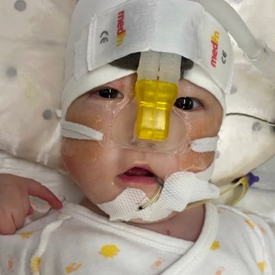 👶2022.12.20 染色体異常 遺伝子疾患NICU PICU GCU卒業生18番目染色体長腕欠損 18qモノソミー 内反足 先天性多発関節拘縮 気管軟化症 停留精巣 低緊張 胃食道逆流 甲状腺低下症 ウエスト症候群 無言フォロー失礼します🙇♀️ 息子の記録