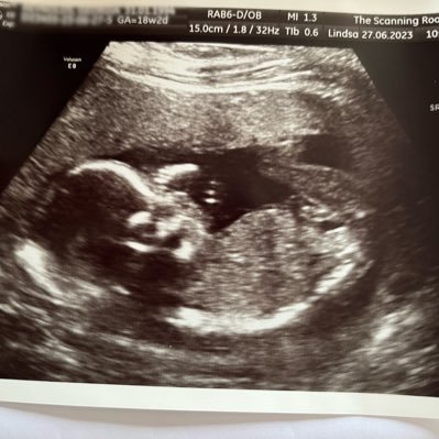 28 🙆🏻♀️ 38 🙆🏼♂️ PCOS + Male Factor 🔬 7 x Clomid 1 MC 👼🏼 IVF1 MC 👼🏼 IVF2 BFN ❌ IVF3 BFN ❌💉 MMC 💔 baby girl born 11/23 🌈🩷
