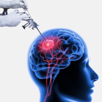 NEUROLOGICAL SURGERY (@nsgythoughts) 's Twitter Profile