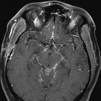 Neurosarcoidosis Papers (@neurosarcpubs) 's Twitter Profile