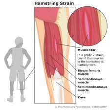 A hamstring injury can be very painful and is common among those who frequently exercise in sports that use the leg muscles, such as jogging, cycling, and even