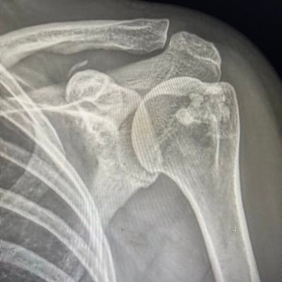 🇲🇽. Orthopaedic and Trauma Surgeon. Shoulder Surgery 🇺🇸🇨🇦🇪🇸
