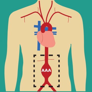 Abdominal Aortic Aneurysm (AAA) Screening
