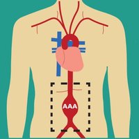 Abdominal Aortic Aneurysm (AAA) Screening (@aaa_screening) 's Twitter Profile