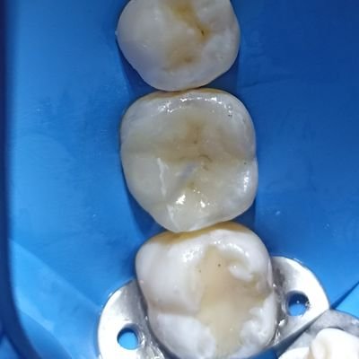 DDS. MSc. Biomimetic Restorative Dentistry
Odontología Avanzada de Alta Calidad y Sarcasmo. - #shareknowladge🧠