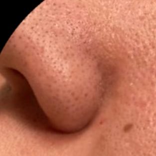 Se241393497S's profile picture. コロナ禍のマスク生活により、これまでの美肌を失った男です。（マスクで肌荒れ→ベピオ・エピデュオの長期使用により肌のバリア機能ぶち壊れ→スキンケアのしすぎ→肌断食で脂漏性皮膚炎発症→弱りきった肌を肌断食にて回復させてます）→改善中、、、