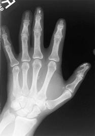 Completely Get Rid of your Multiple Sclerosis no matter what type you have or how long you've suffered from it http://t.co/NWZVQYF40x