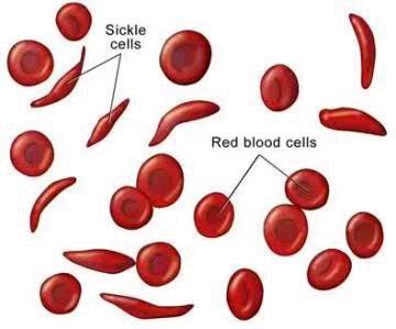 All u need 2 knw bout sickle cell anemia. #Teamgoodhealth.....Rest in Power Lamide
