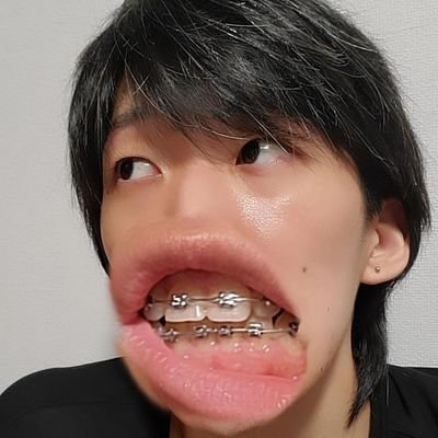 生まれつき下顎前突。顎変形症適応であったが、中学時代に一般歯科で非抜歯矯正失敗。2023.10月～再矯正&顎変形症診断(非抜歯矯正で緩和されたが面影のある下顎前突かと思いきや、ガミースマイルで診断)。2025年8月21日 手術済み。向井理になりました。舌小帯切り、上前歯サイズダウンも予定。矯正・顎変仲間に幸あれ～🦷