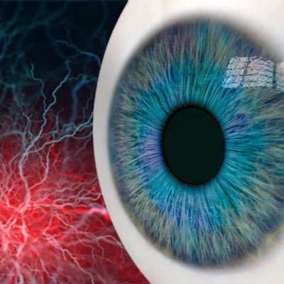 REVISION_trial's profile picture. Early REperfusion Therapy with Intravenous Thrombolysis for Recovery of VISION in Acute Central Retinal Artery Occlusion: phase III randomized trial