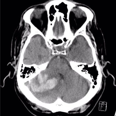 Intracerebral Hemorrhage (ICH) is an emergency and should be treated as one.

Dedicated to the advancement of ICH care through RESEARCH and EDUCATION